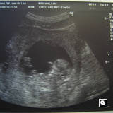1. Okt '08: 2. Ultraschall (12. SW)